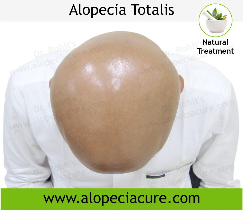 Primary Alopecia Areata